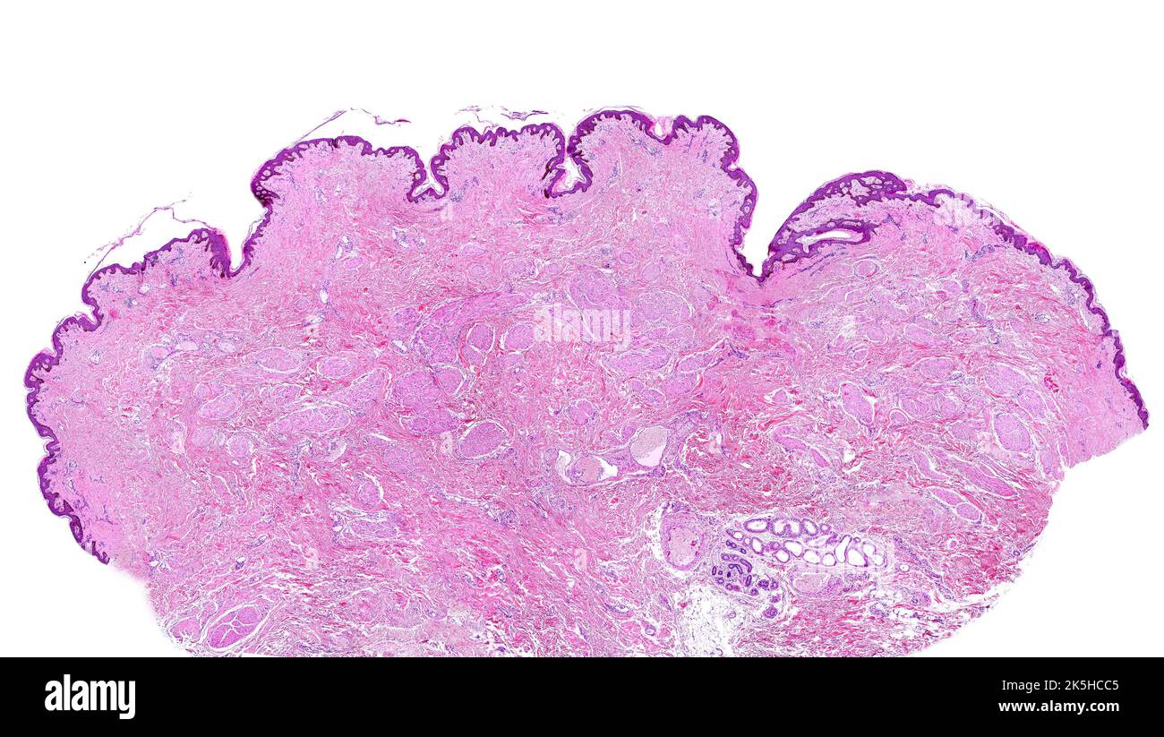Micrographe à microscope à lumière faible puissance d'une mamelon de sein humain. Il est recouvert d'une peau fine pigmentée. Sur le tissu conjonctif il y a beaucoup de fascic Banque D'Images
