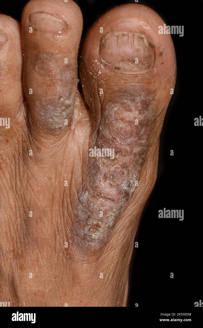 Eczéma ou infection fongique au pied de l'homme asiatique. Vue en gros plan. Banque D'Images
