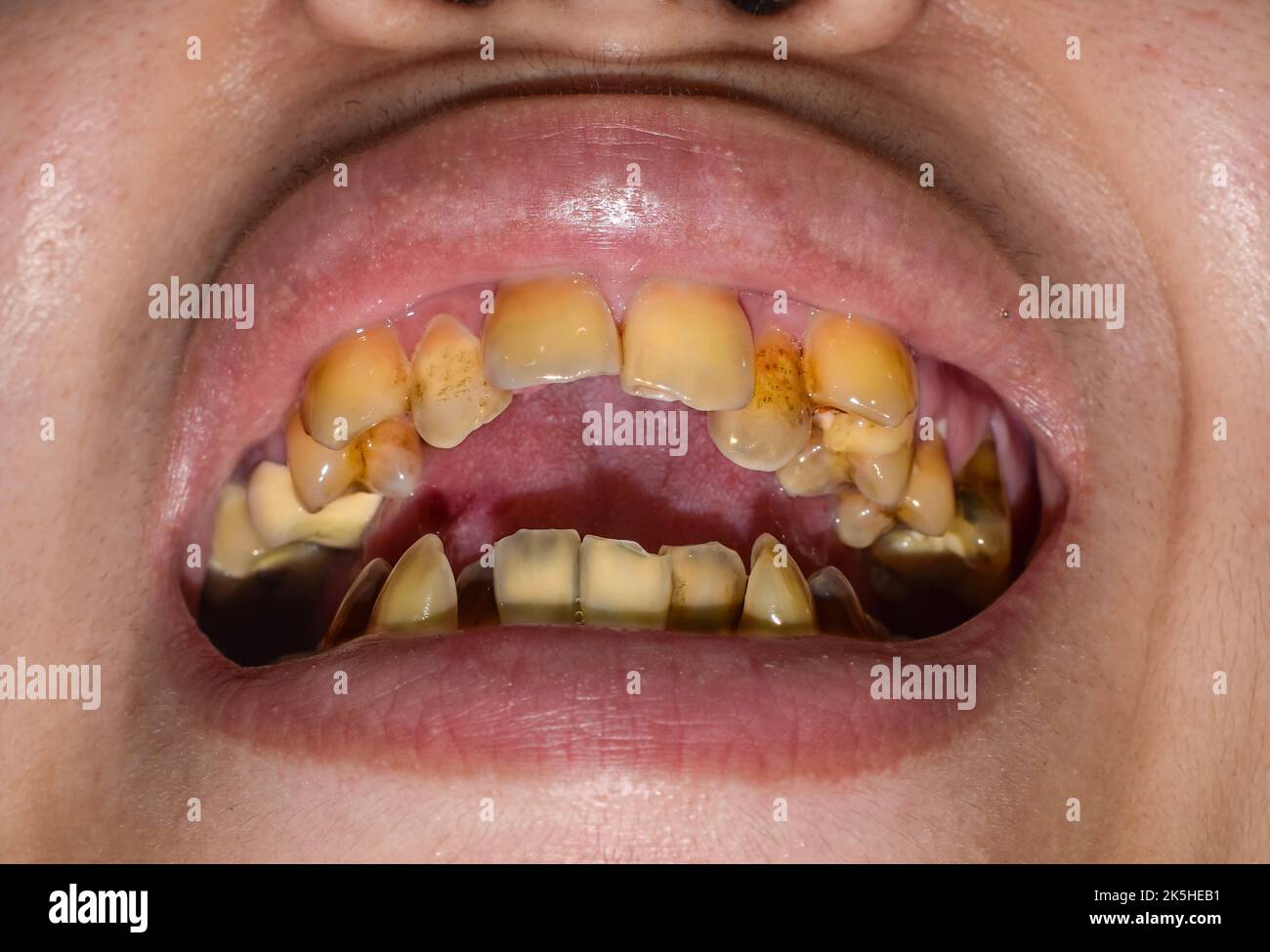 Dents surpeuples avec taches de tabac de couleur jaune. Mauvaise hygine  bucco-dentaire Photo Stock - Alamy