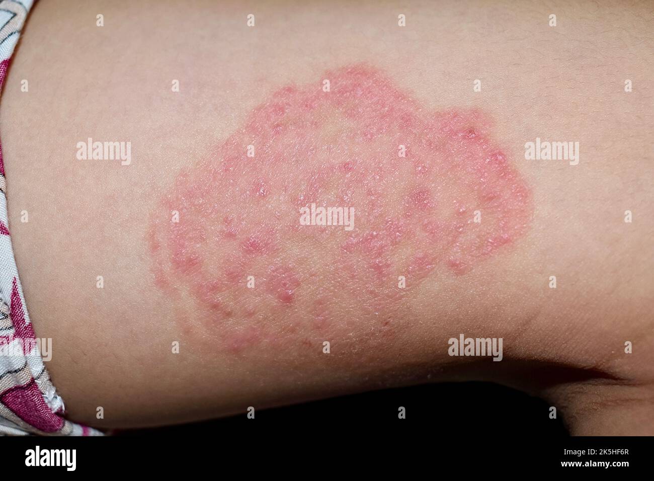 Infection fongique appelée tinea corporis dans la cuisse de l'enfant d'Asie du Sud-est. Ver à anneau Banque D'Images