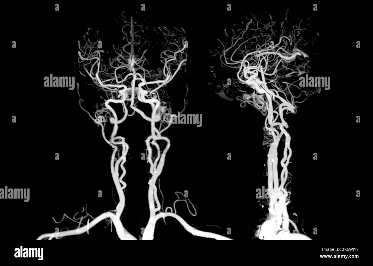 Angiographie TDM cérébrale ou TDM cérébrale 3D rendu de l'image pour le diagnostic de l'anévrisme de l'artère cérébrale. Banque D'Images
