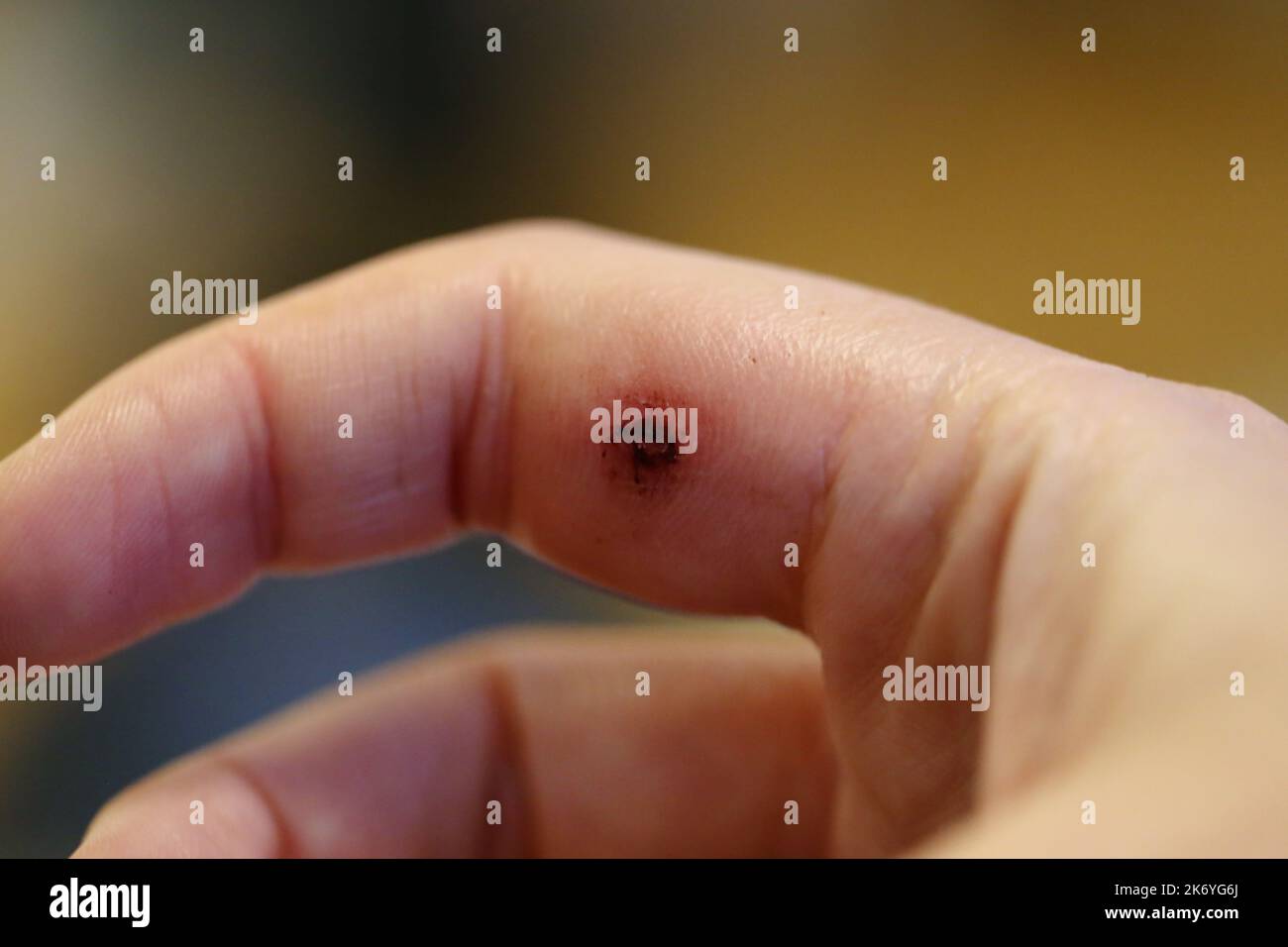 Marque de morsure de chien sur l'index d'une femme blanche. Il y a un peu de gonflement, rougeur, ecchymoses, sang sec et début d'un eschar. Macro médical eux Banque D'Images