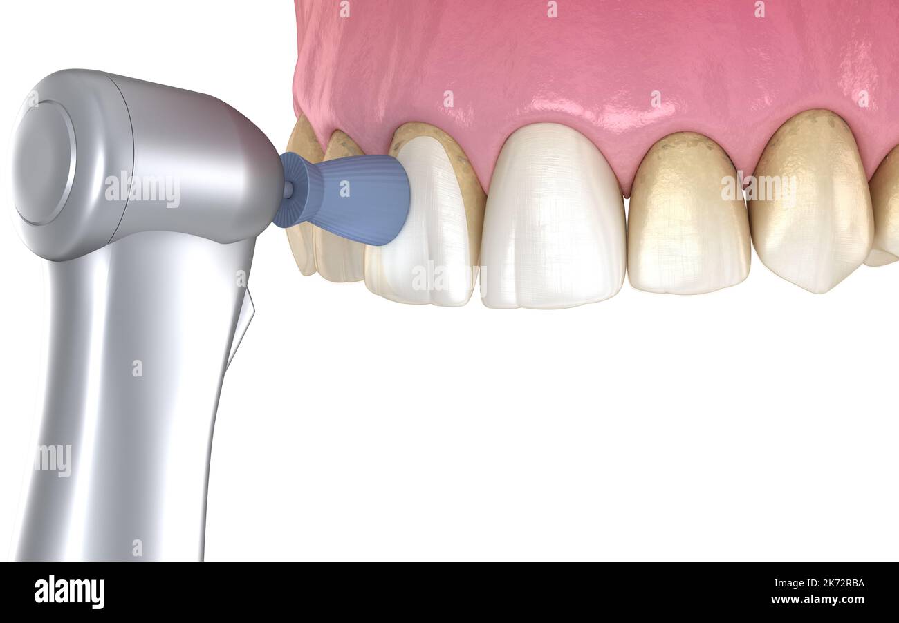Procédure de polissage des dents avec brosse professionnelle et gel. Illustration 3D précis médicalement Banque D'Images