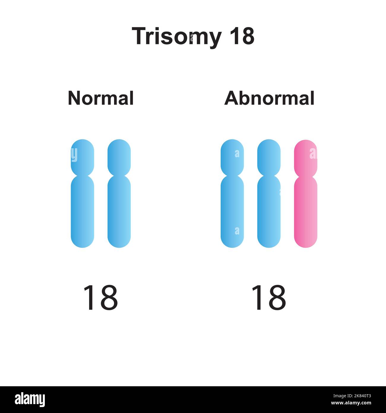 Conception scientifique du syndrome d'Edwards (trisomie 18). Symboles colorés. Illustration vectorielle. Illustration de Vecteur
