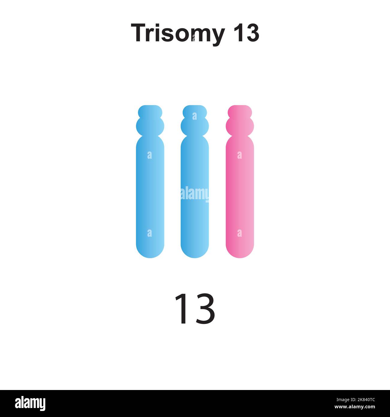 Conception scientifique du syndrome de Patau (trisomie 13). Symboles colorés. Illustration vectorielle. Illustration de Vecteur