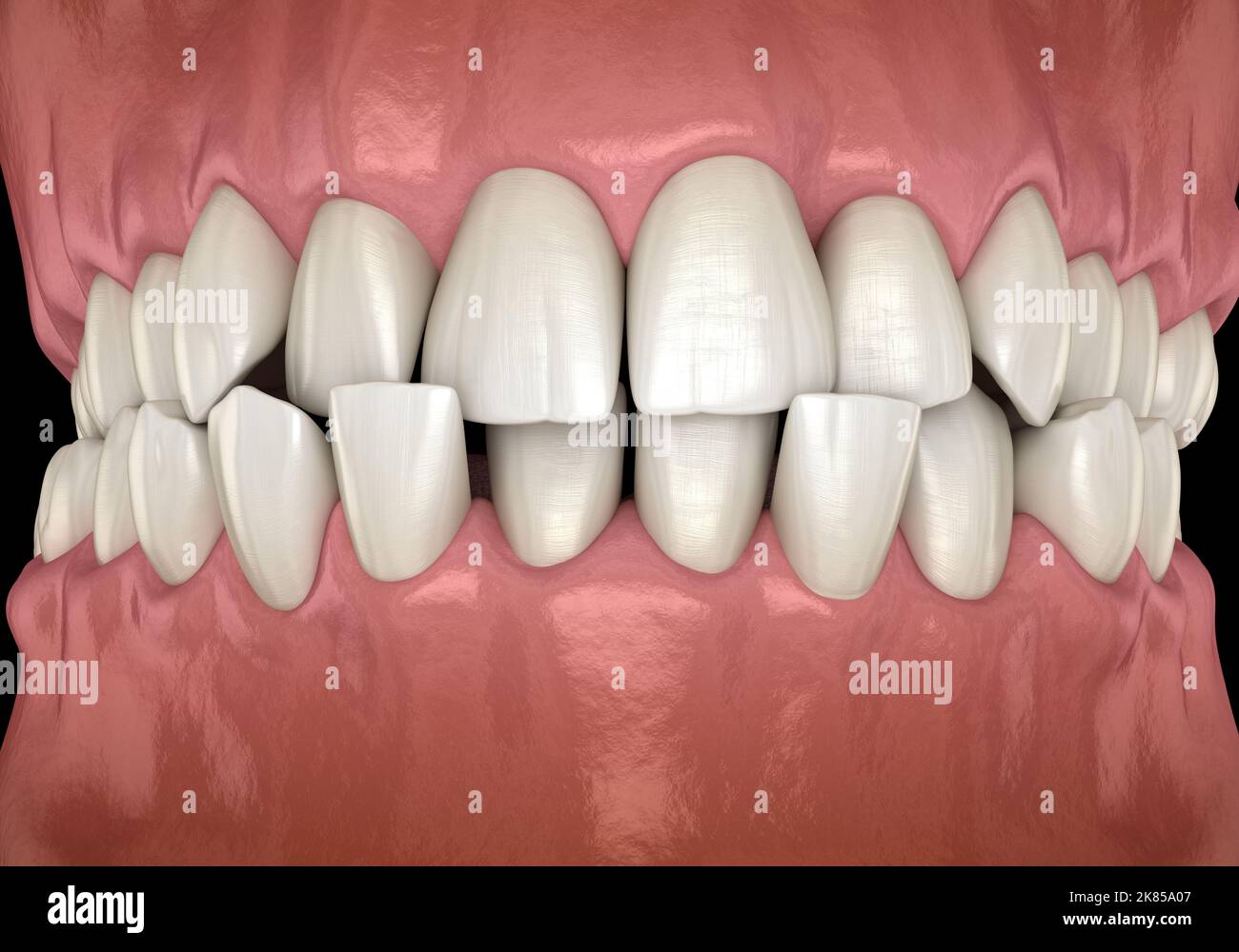 Pince Dentaire V-Stop Pour Orthodontie - Médentra - Acier Inoxydable - Pour Plier Les Arcs Dentaires