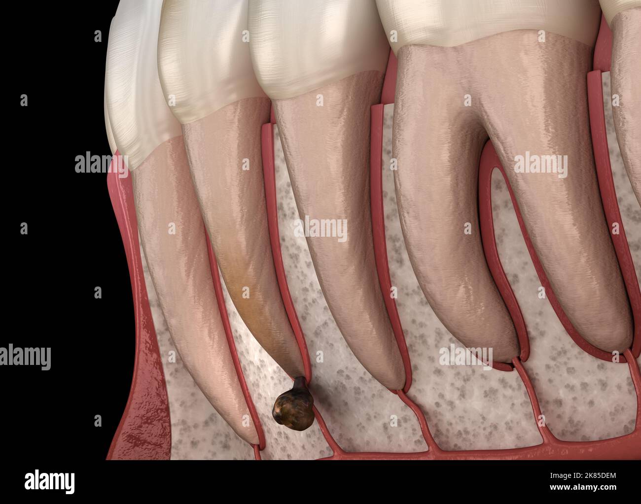 Dent de périostite - morceau sur la gomme au-dessus de la dent. Illustration dentaire 3D précise sur le plan médical Banque D'Images