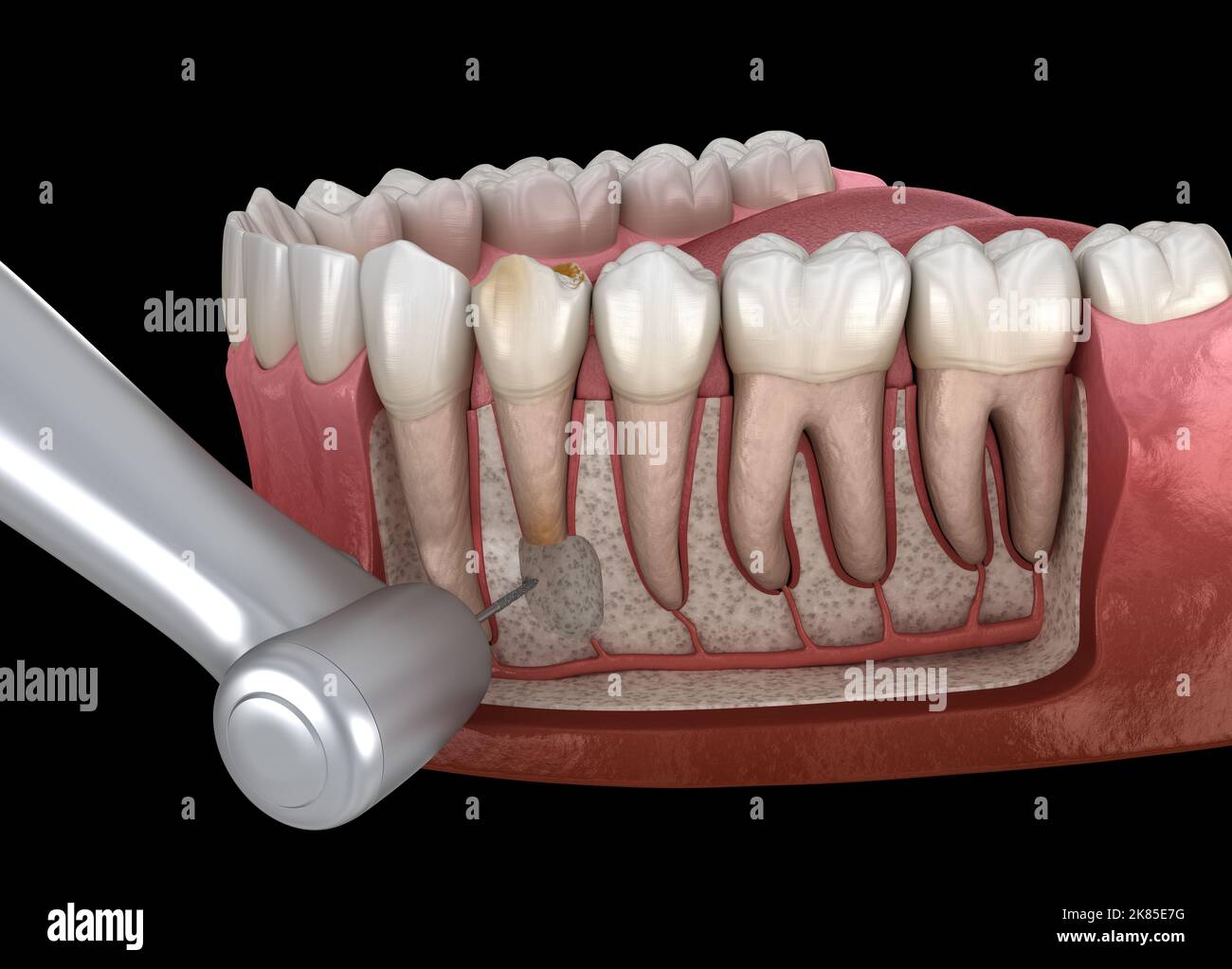 Chirurgie de cystectomie dentaire - récupération après périostite . Illustration 3D médicale précise Banque D'Images