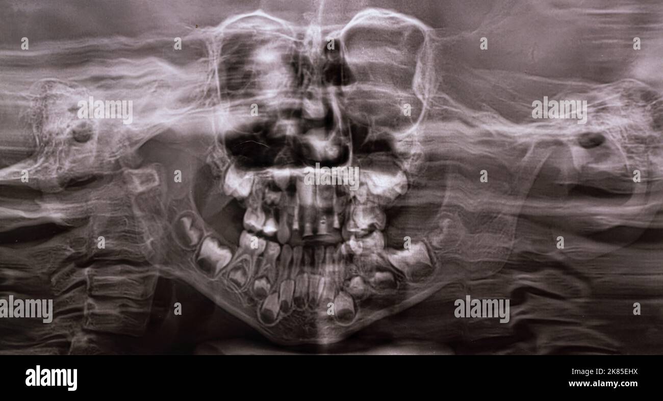 Une radiographie panoramique montre plusieurs dents incrustées et affectées sur la mâchoire supérieure et inférieure des dents des enfants Banque D'Images