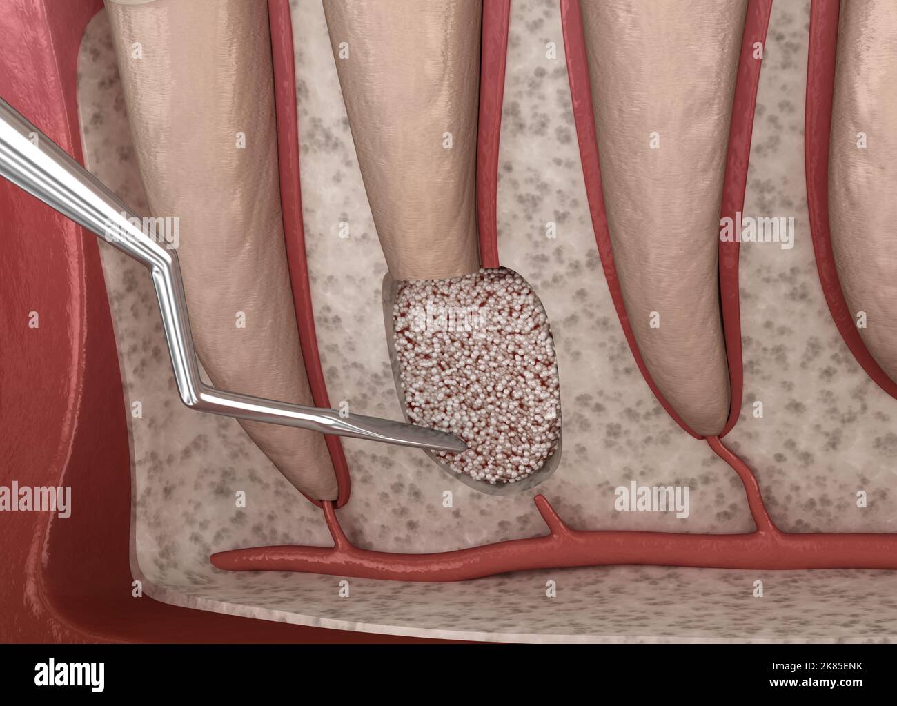 Chirurgie de cystectomie dentaire - récupération après périostite . Illustration 3D médicale précise Banque D'Images