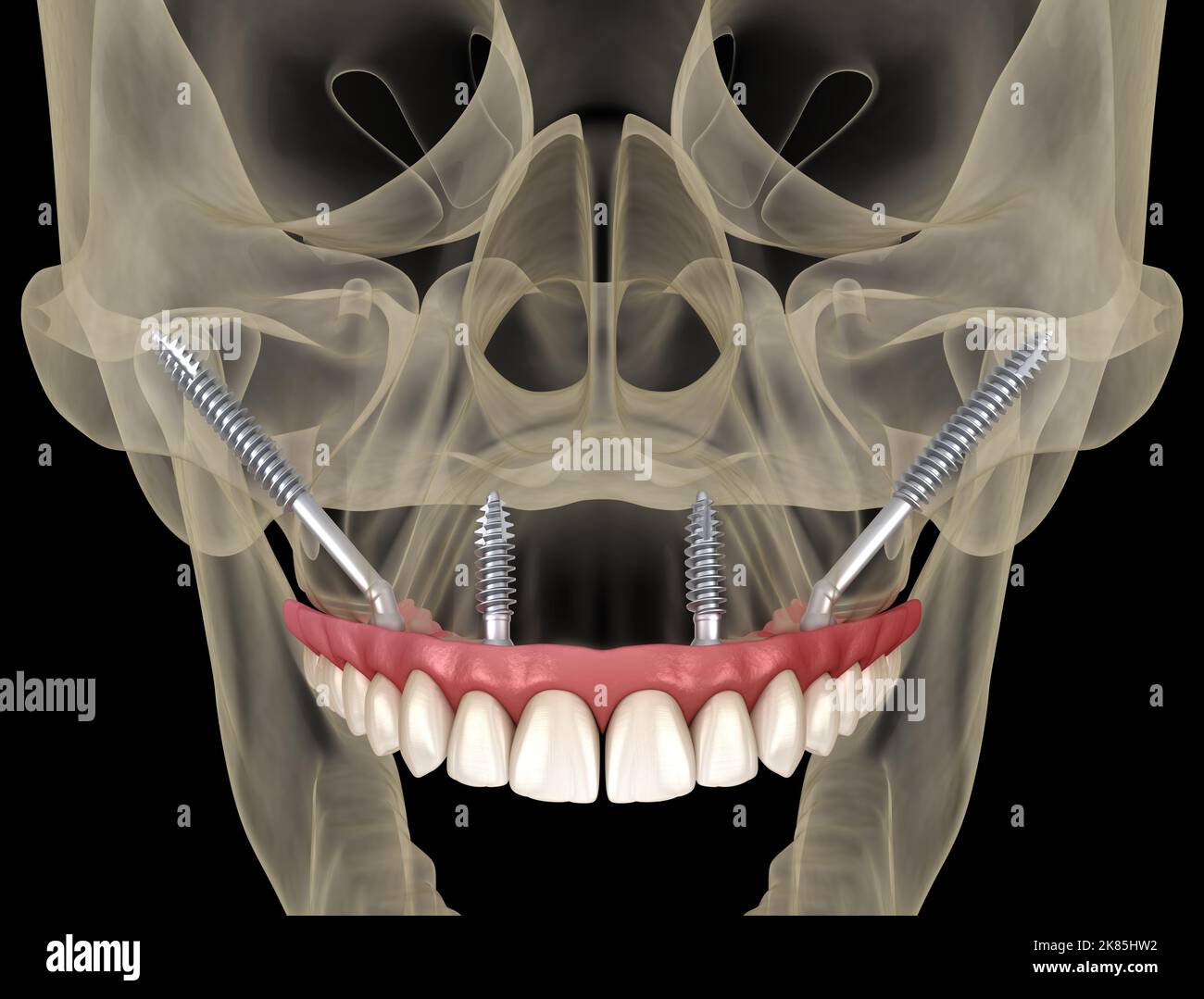Prothèse maxillaire soutenue par des implants zygomatiques. 3D illustration médicale précise des dents et des prothèses dentaires humaines Banque D'Images