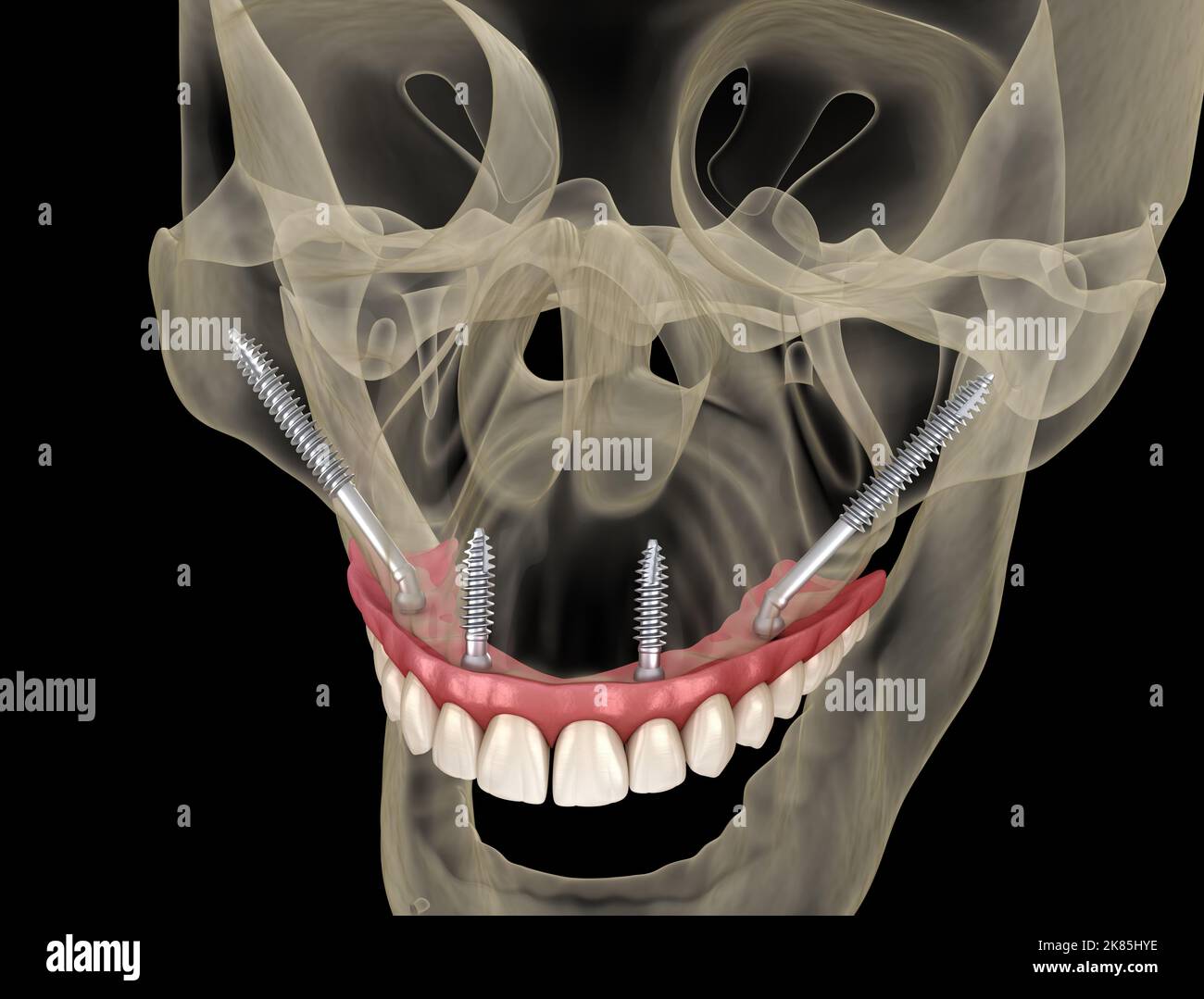 Prothèse maxillaire soutenue par des implants zygomatiques. 3D illustration médicale précise des dents et des prothèses dentaires humaines Banque D'Images