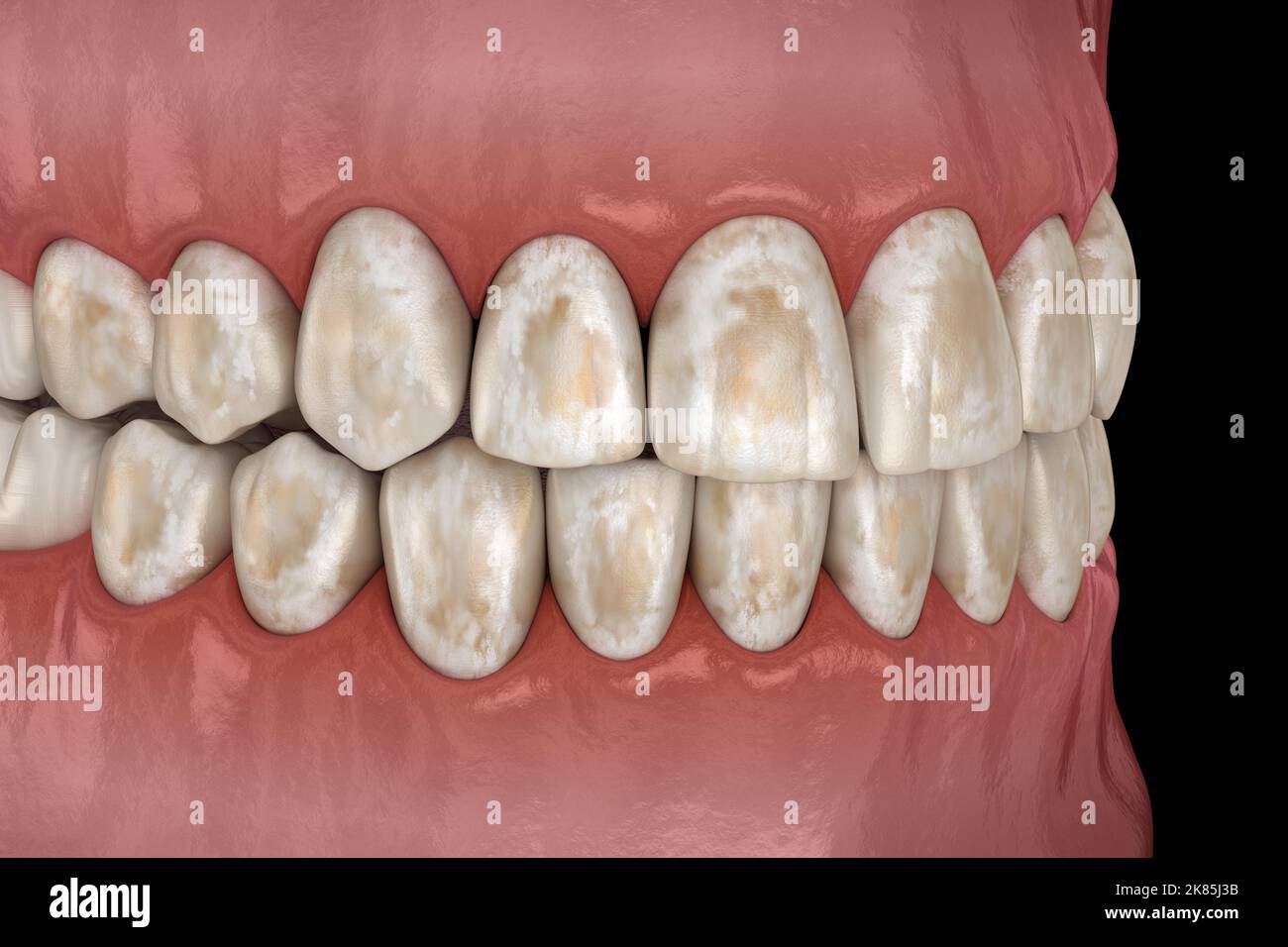 D min ralisation Des Dents limination Des Min raux Des Tissus Durs d-min-ralisation-des-dents-limination-des-min-raux-des-tissus-durs
