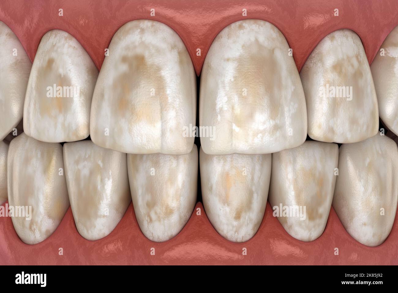 Déminéralisation des dents, élimination des minéraux des tissus durs : émail, dentine et cémétu. Illustration 3D médicale précise. Banque D'Images