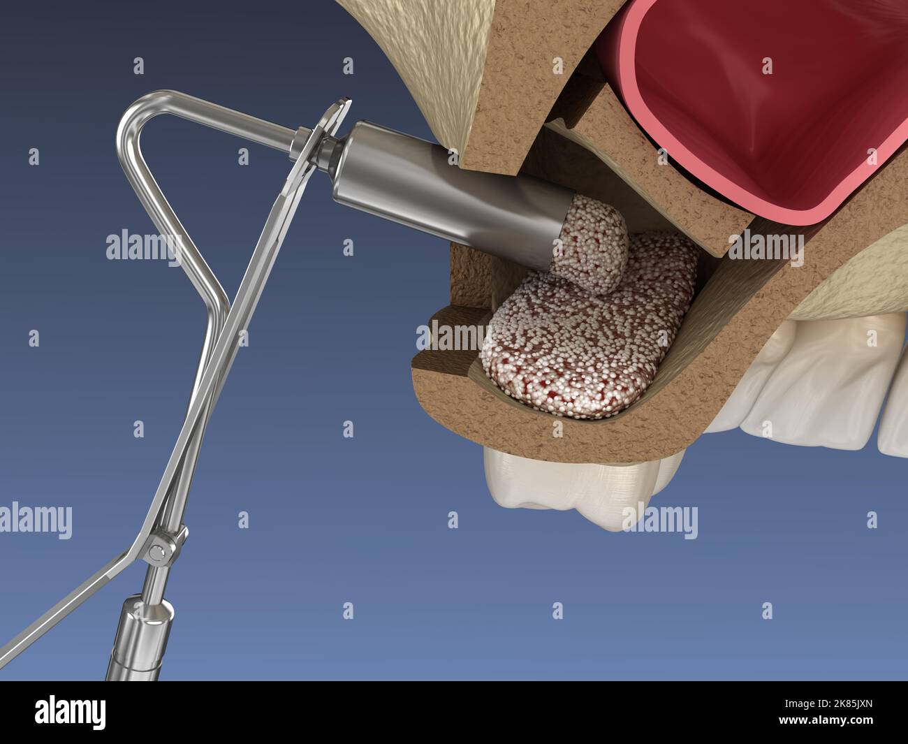 La chirurgie d'ascenseur de sinus - Ajout de nouveaux os. 3D illustration Banque D'Images