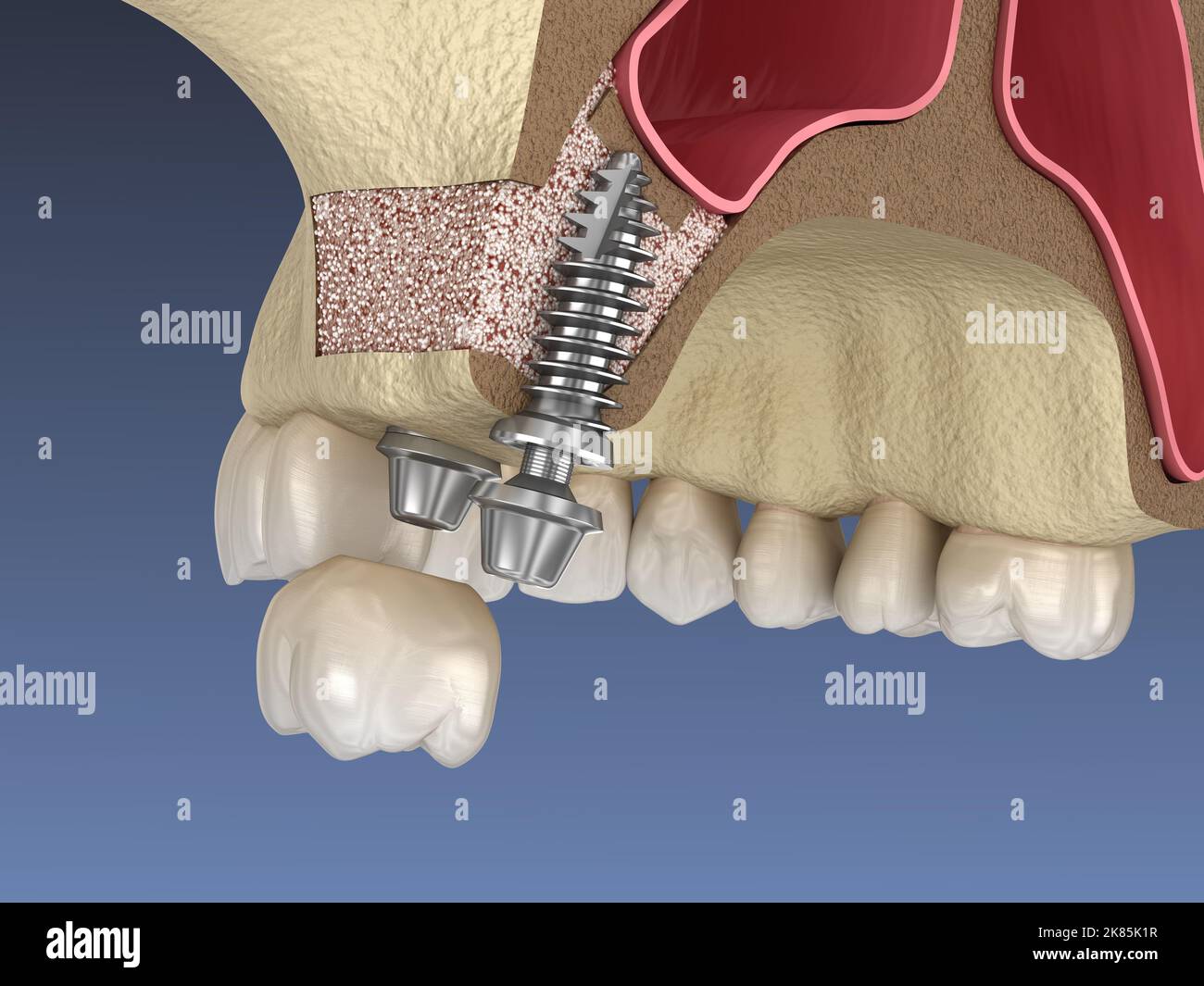 La chirurgie d'ascenseur de sinus - installation de l'implant. 3D illustration Banque D'Images