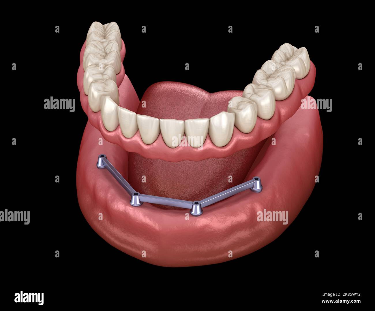 Prothèse mandibulaire amovible avec gomme sur le système 4 supporté par des implants. 3D illustration médicale précise des dents et des prothèses dentaires humaines Banque D'Images