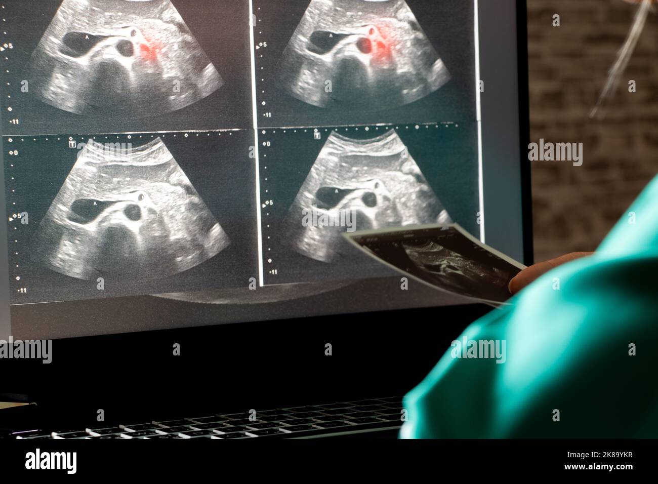 Échographie de l'abdomen d'une femme sur un écran d'ordinateur portable dans un bureau de médecin, diagnostic d'une douleur abdominale, médecine Banque D'Images