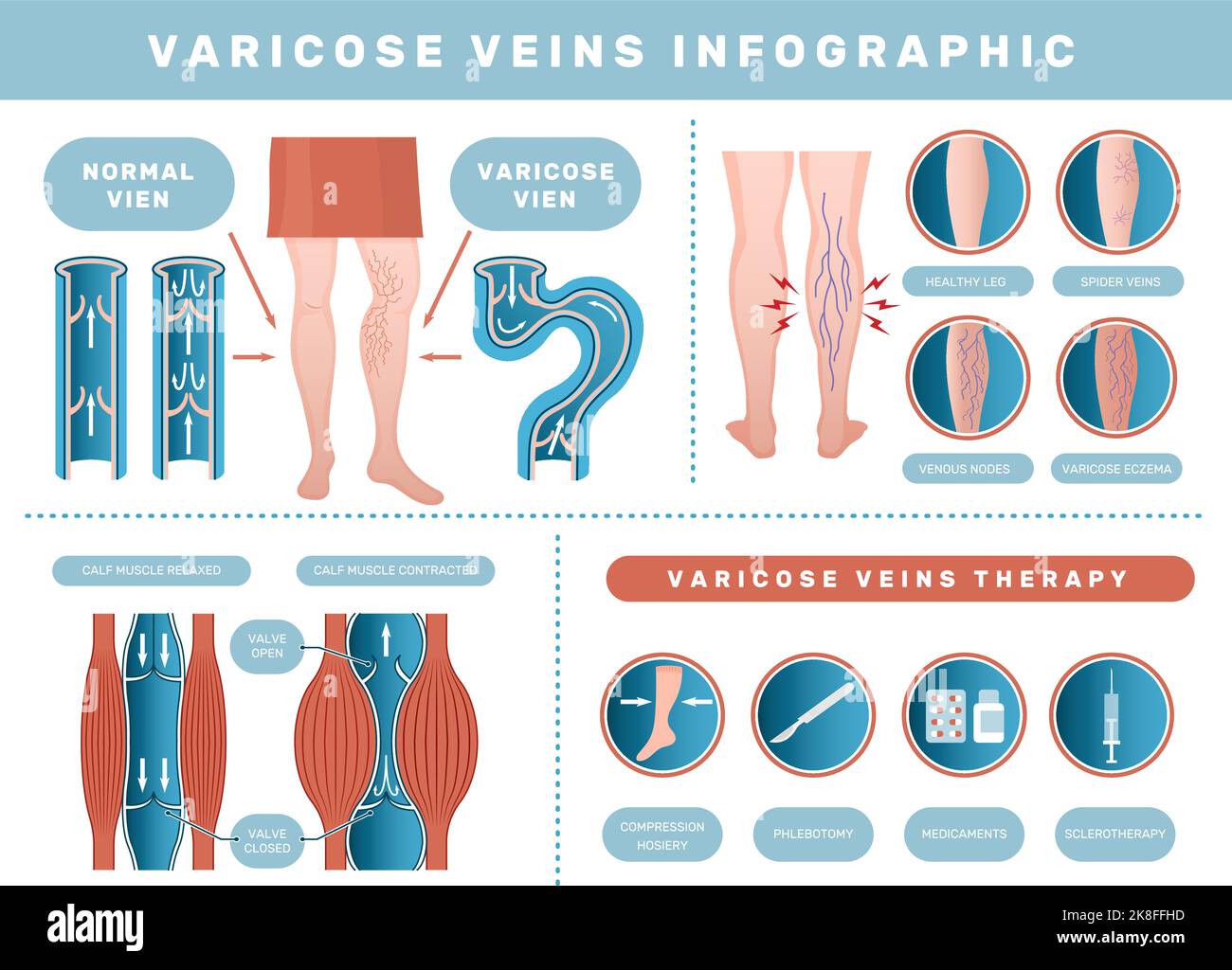 Infographie varices. Maladie veineuse problèmes médicaux de santé avec le sang humain ensemble de modèles de vecteur récent veineux Illustration de Vecteur