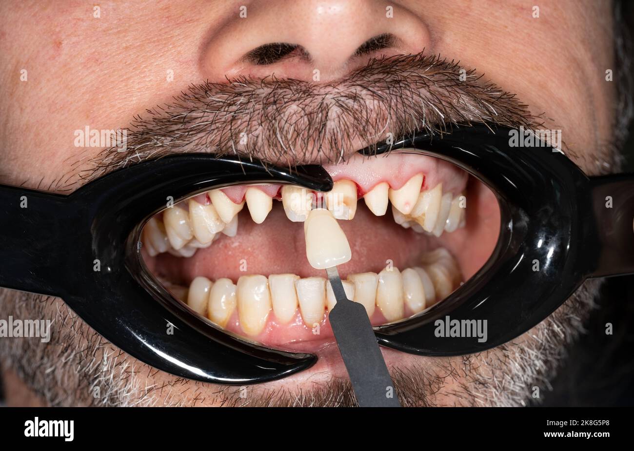 Détermination de la couleur des dents. Compatibilité de la couleur de l'émail des dents avec le tableau de blanchiment Banque D'Images
