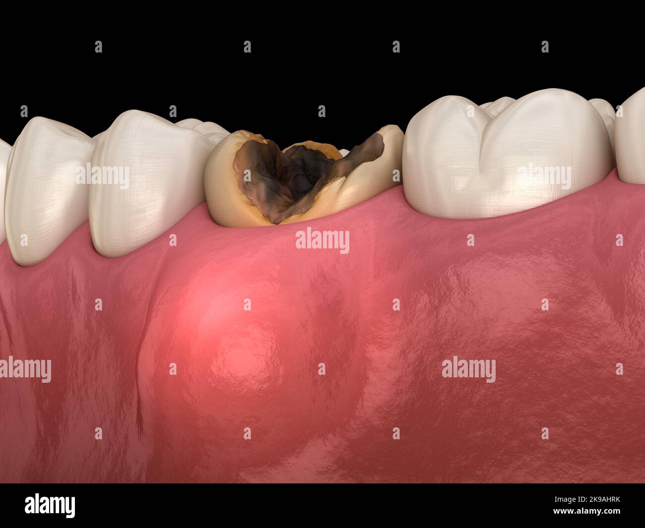 Parodontite et inflammation des gencives. Illustration dentaire 3D précise sur le plan médical Banque D'Images