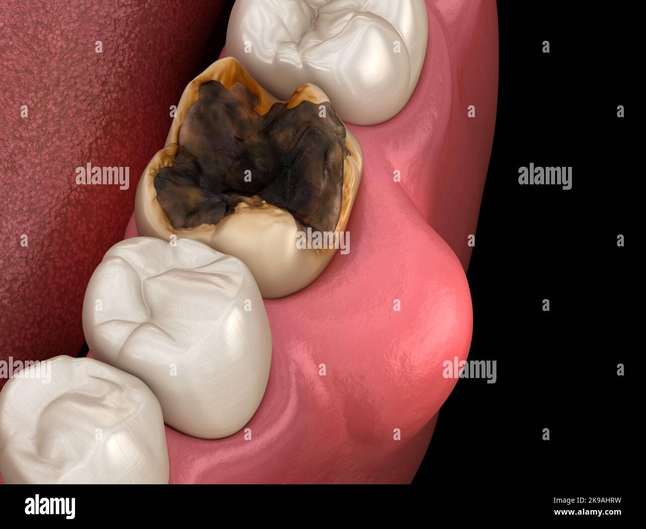 Parodontite et inflammation des gencives. Illustration dentaire 3D précise sur le plan médical Banque D'Images