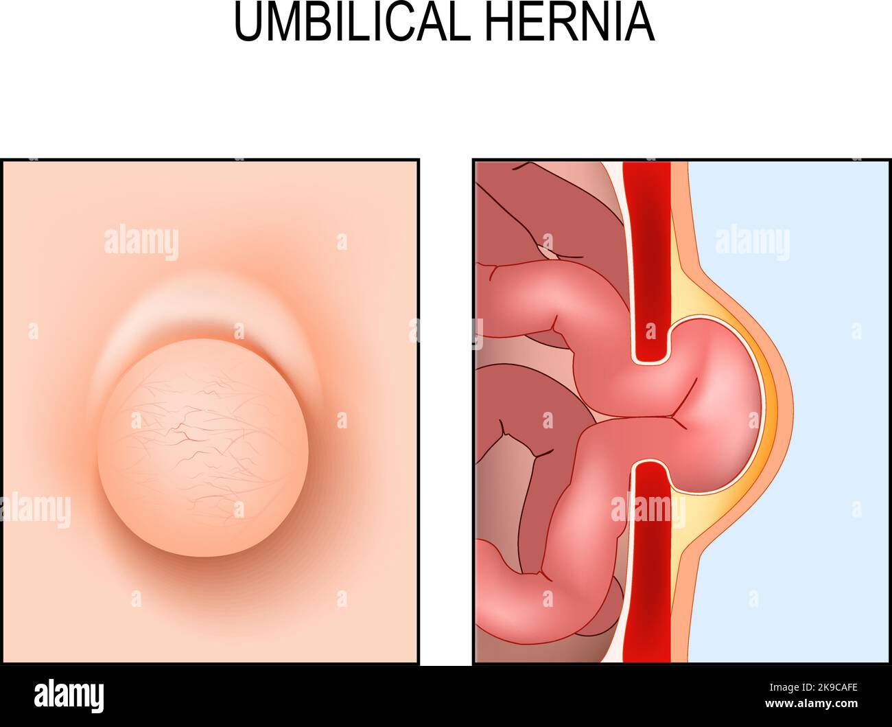 Hernie ombilicale. Coupe transversale de l'abdomen avec l'intestin grêle, le muscle et la paroi abdominale. Vue de face du ventre humain avec sac hernial dans l'ombilicu Illustration de Vecteur Hernie ombilicale. Coupe transversale de l'abdomen avec l'intestin grêle, le muscle et la paroi abdominale. Vue de face du ventre humain avec sac hernial dans l'ombilicu Illustration de Vecteur