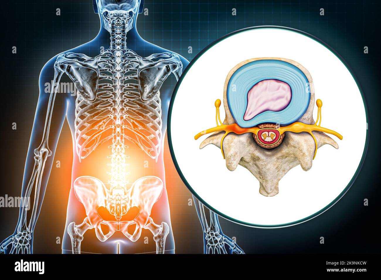 Hernie lombaire et vertèbre avec disque hernié diagramme médical 3D illustration de rendu. Mal de dos, pathologie de la colonne vertébrale, lésion, ostéologie, soins de santé, sc Banque D'Images