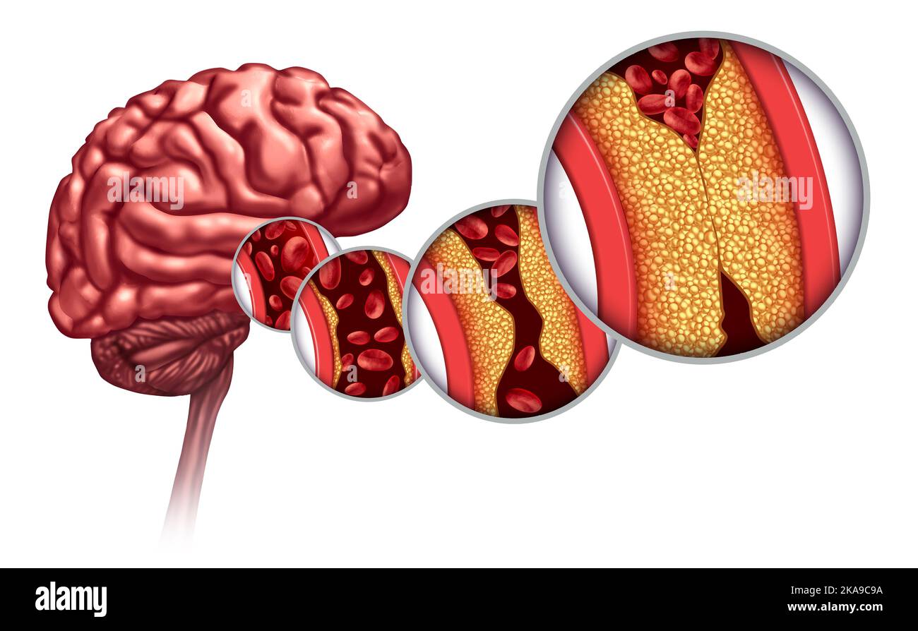 L'athérosclérose et l'accident vasculaire cérébral comme un trouble cérébral causé par les cellules sanguines bloquées par la graisse et le cholestérol s'accumuler comme un blocage et un durcissement d'artère Banque D'Images