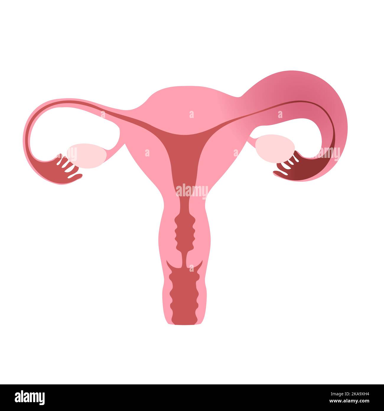 Illustration plate de l'utérus humain démontrant un tube de Fallope sain et un tube enflammé. Illustration de Vecteur