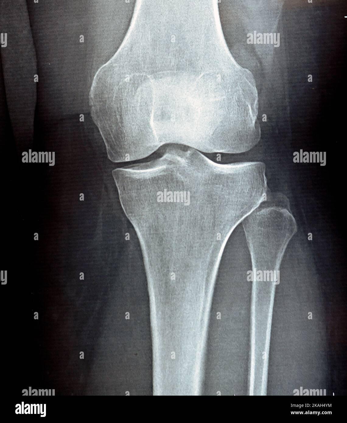 Rayons X simples sur l'articulation du genou montrant un rétrécissement de l'espace articulaire et une sclérose sous-chondrale sur le compartiment médial (épaississement de l'os qui se produit dans les articulations aff Banque D'Images