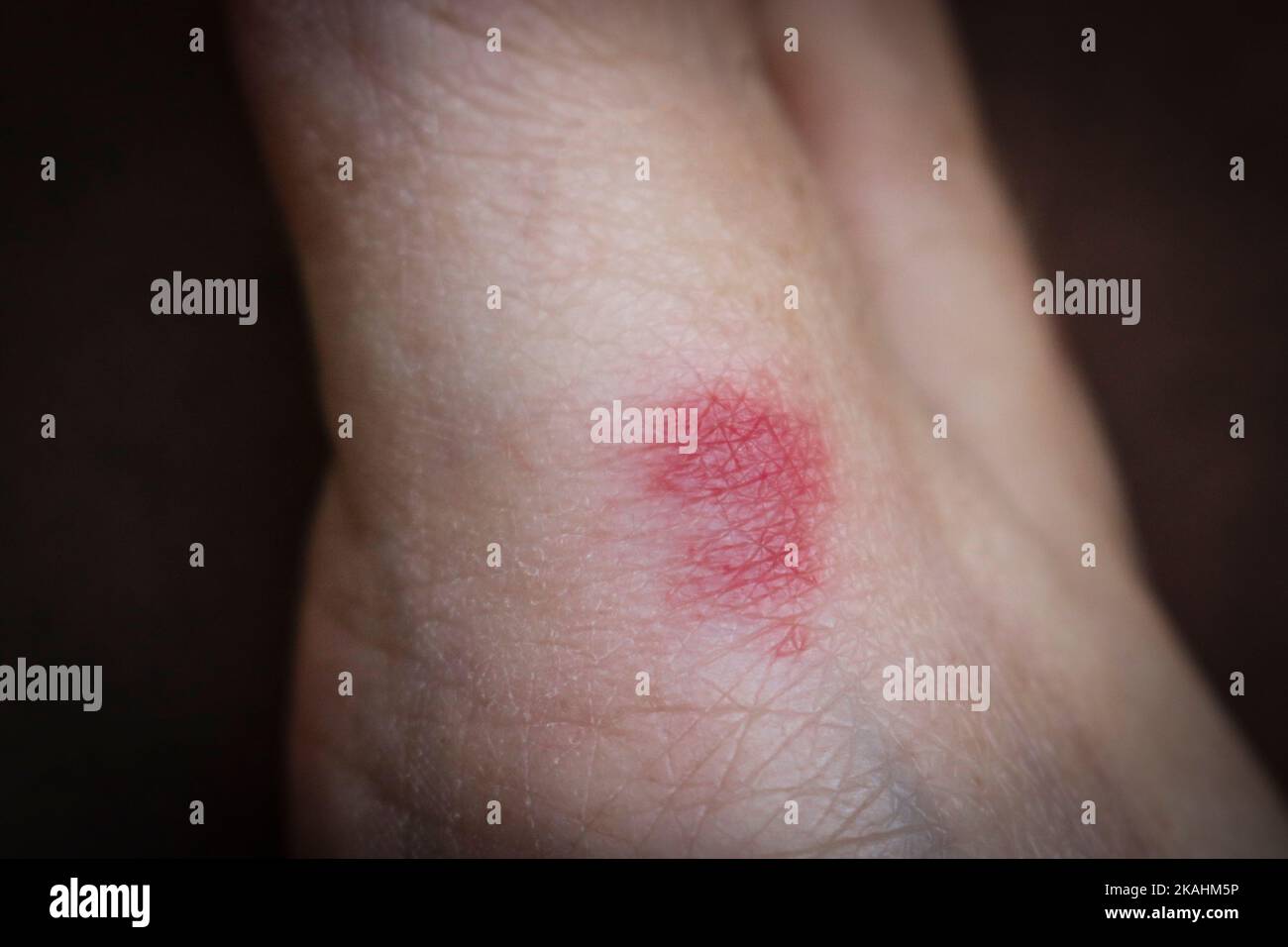 Bite ANT sur la peau du pied. Inflammation rouge causée par des lésions cutanées. Banque D'Images