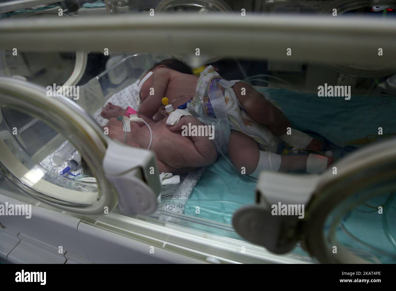 Une paire de sœurs jumelles jointes, nées samedi, se trouvent dans un incubateur à l'hôpital de Shifa, dans la ville de Gaza, le 26 octobre 2017. Le Dr Allam Abu Hamda, un nouveau-né spécialiste de l'hôpital Shifa de Gaza, a déclaré lundi que les filles sont en état de santé 'table' et que les médecins ont commencé aux nourrir, mais ils auront besoin de soins à l'étranger. (Photo de Majdi Fathi/NurPhoto) Banque D'Images
