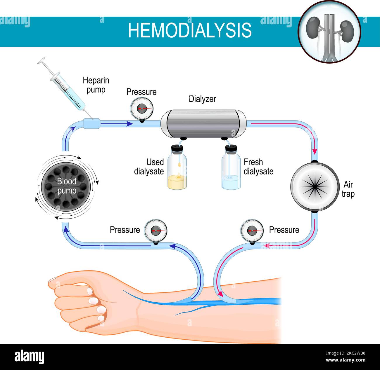 Le principe de la machine d'hémodialyse. Processus de dialyse. L'hémodialyse détourne le sang dans une machine externe, où il est filtré Illustration de Vecteur