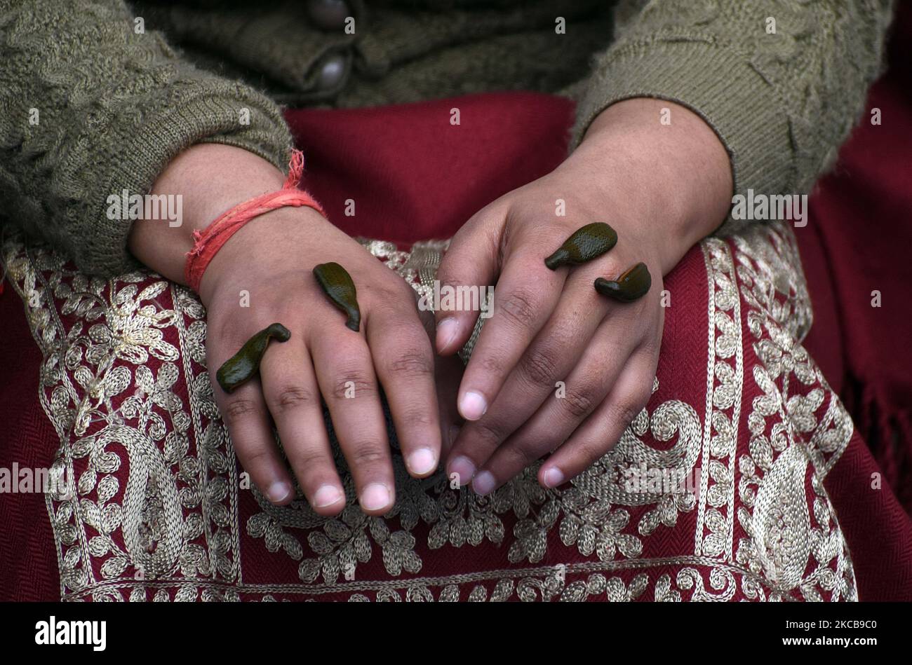 SRINAGAR, CACHEMIRE, INDE-MARS 21: Les sangsues sont placées par un praticien local sur les mains d'une femme pour sucer le sang impur comme un moyen de traitement de peau à l'occasion de Nowruz, le début de l'année dans le calendrier perse à Srinagar, Cachemire sur 21 mars 2021. Le jour de Nowruz, les personnes souffrant de divers maux de peau se rassemblent à Hazratbal, Srinagar pour recevoir le traitement leech. (Photo par Faisal Khan/NurPhoto) Banque D'Images