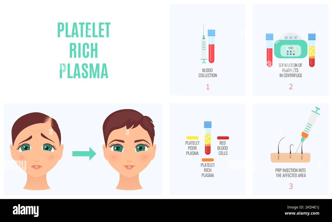 Traitement de perte de cheveux PRP, illustration conceptuelle Banque D'Images