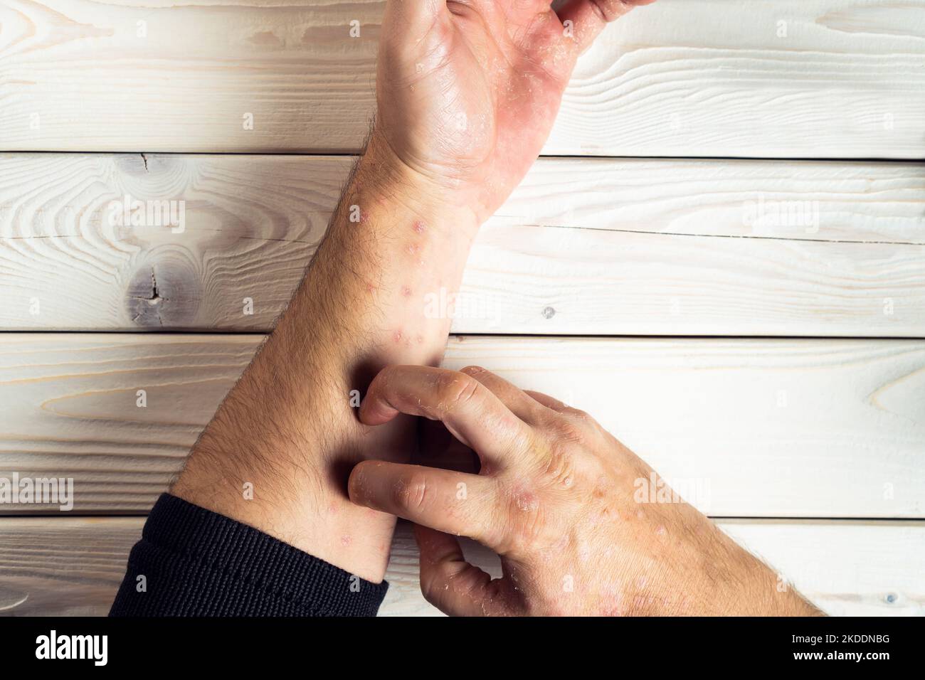 Vue de dessus d'un homme méconnaissable souffrant de psoriasis, égratignures rouges, enflammées, éruptions cutanées sur la peau du bras avec les doigts sur fond de bois blanc. Banque D'Images Vue de dessus d'un homme méconnaissable souffrant de psoriasis, égratignures rouges, enflammées, éruptions cutanées sur la peau du bras avec les doigts sur fond de bois blanc. Banque D'Images
