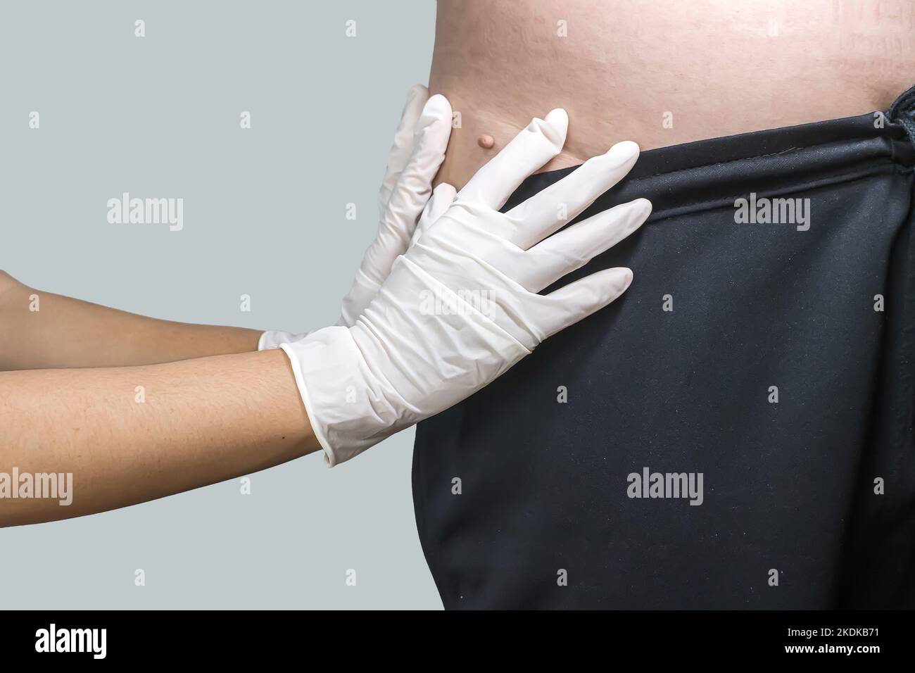 Étiquette de peau ou acrochondon ou fibrome mou est un coffre-fort. Il n'ont pas effet à l'organisme. Elle se produit habituellement au cou, le visage, les aisselles et le corps. Banque D'Images