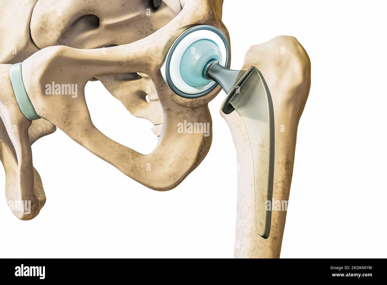 Prothèse de hanche ou implant isolé sur fond blanc en gros plan. Illustration du rendu 3D de remplacement de l'articulation de la hanche ou de la tête fémorale. Médecine, médical an Banque D'Images