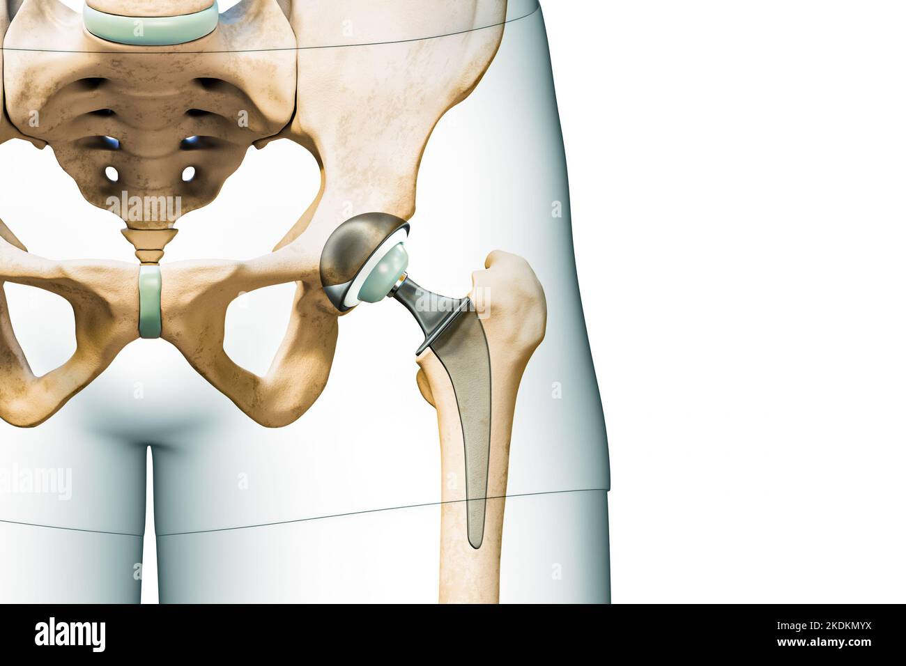 Prothèse de hanche ou implant isolé sur fond blanc avec espace de copie et contours du corps. Remplacement de l'articulation de la hanche ou de la tête fémorale 3D illustrat de rendu Banque D'Images