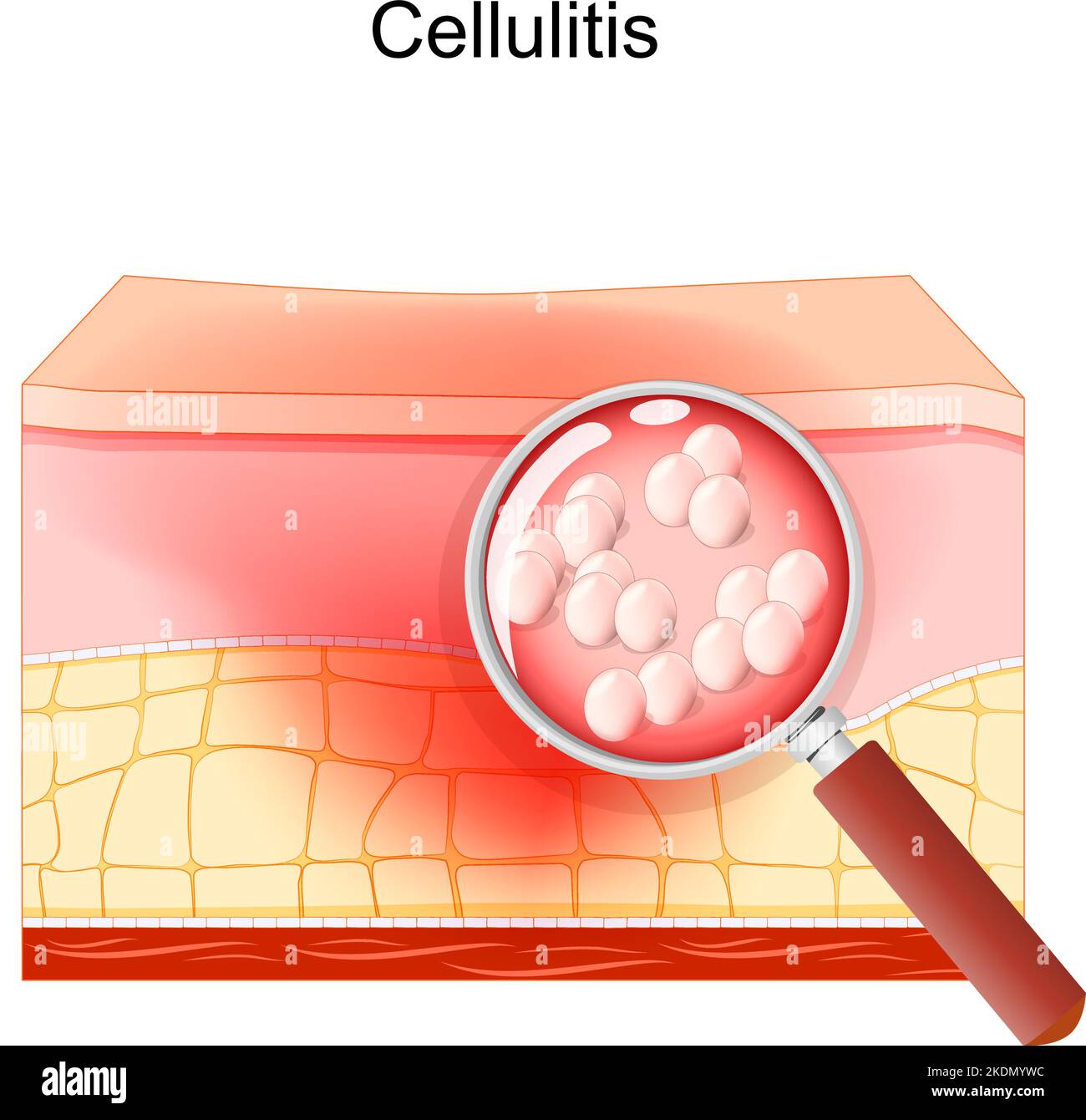cellulite. Coupe transversale de couches de la peau humaine. Tissu ...