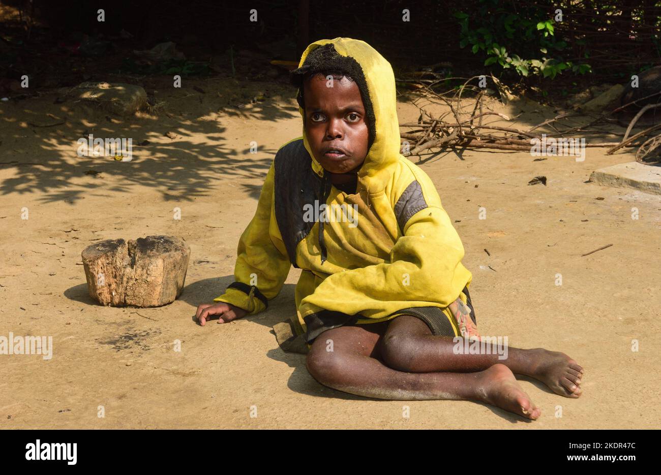 Hachai Baske 15 ans à Jadugoda souffre d'un gonflement de la tête de  naissance. La tumeur grandit avec son âge. Les sections locales et les ONG  disent que les maladies et les handicaps sont dus aux radiations de  l'extraction de l'uranium dans les zones ...