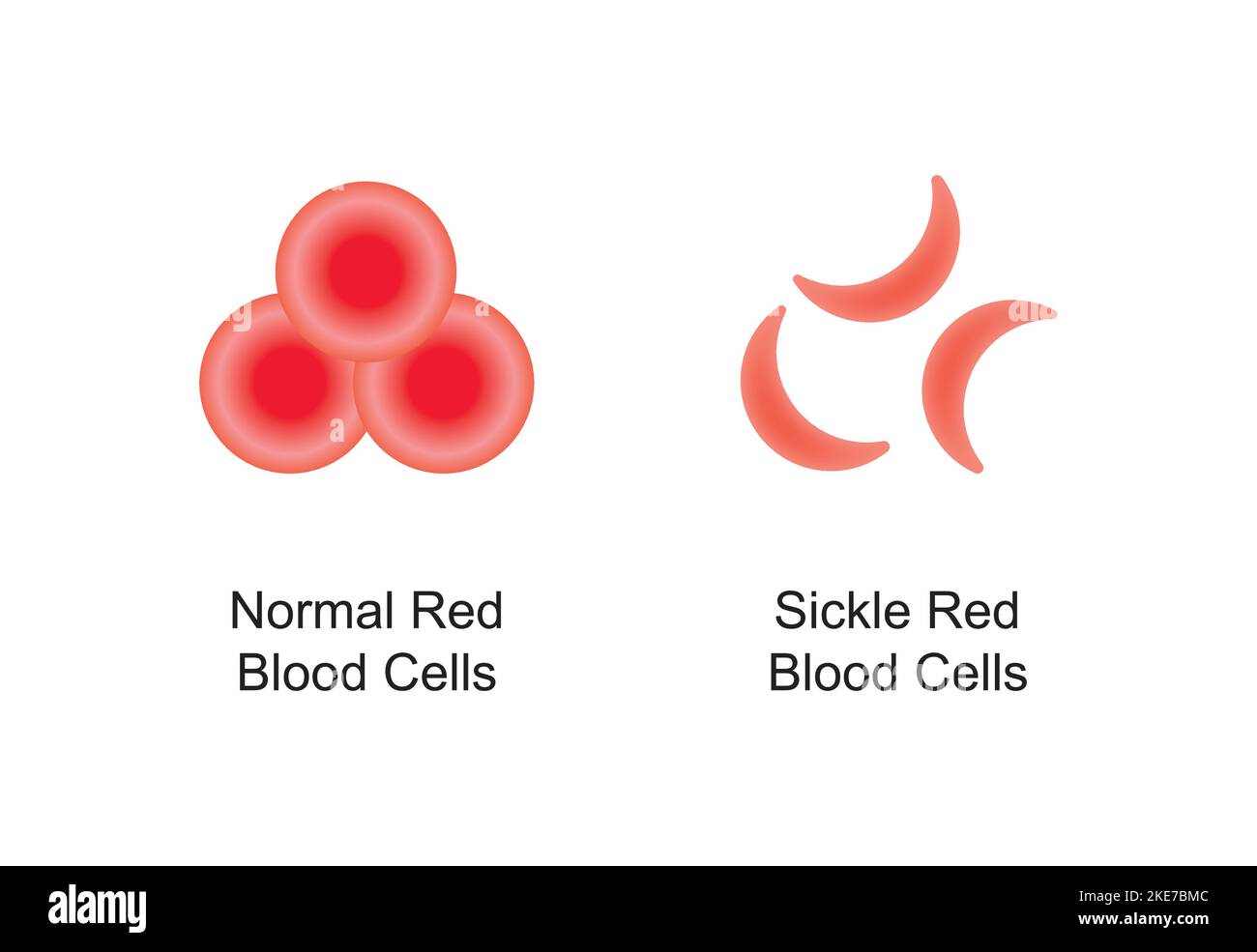 Conception scientifique de la comparaison des globules rouges normaux et de la faucille. Symboles colorés. Illustration vectorielle. Illustration de Vecteur