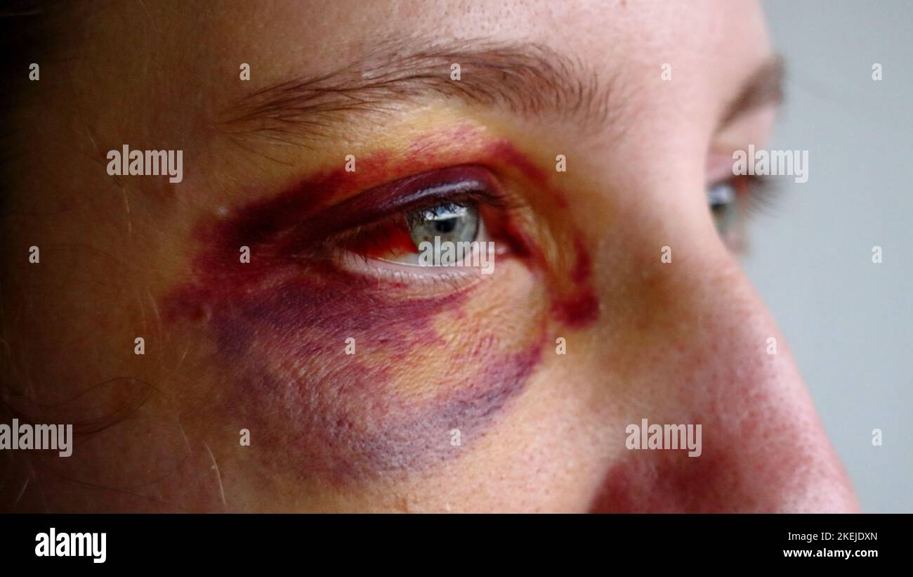 Gros plan du visage de la femme blessée avec un œil noir et un œil de sang Banque D'Images