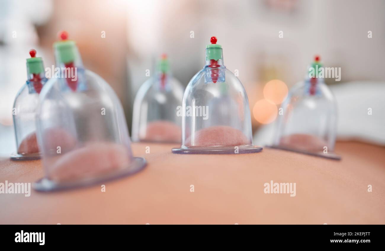 Thérapie de cupping, spa asiatique de physiothérapie et de massage pour la santé spirituelle zen de guérison, personne avec douleur de dos et de soulagement de stress. Détox alternatif Banque D'Images
