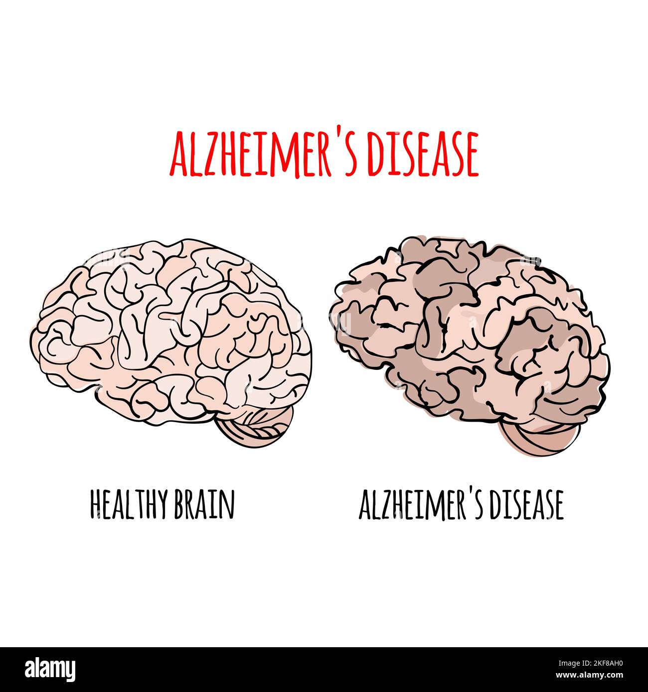 Maladie D'ALZHEIMER perte de mémoire dommages au cerveau médecine traitement de la santé bannière affiche vectorielle dessinée à la main Illustration Illustration de Vecteur