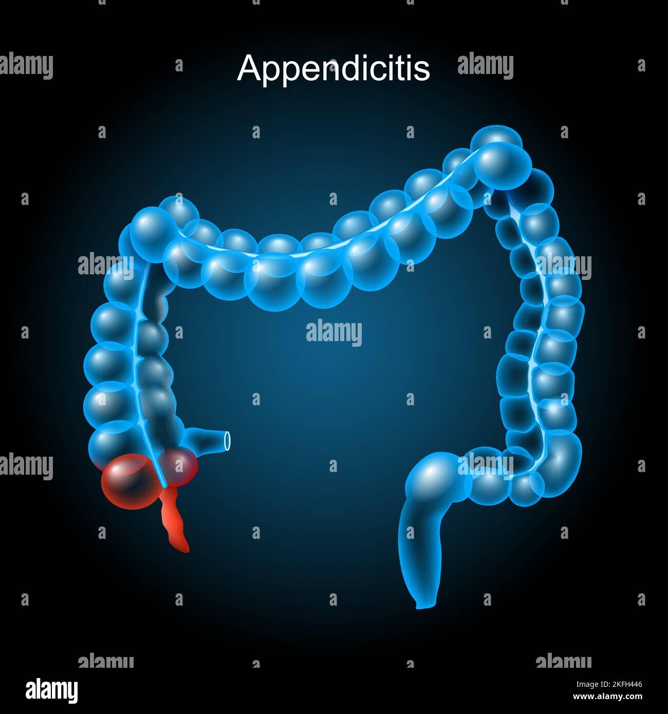 Appendicite. Inflammation de l'appendice. Gros intestin sur fond sombre. Tractus gastro-intestinal. Système digestif. Anatomie du corps humain. Vecteur Illustration de Vecteur