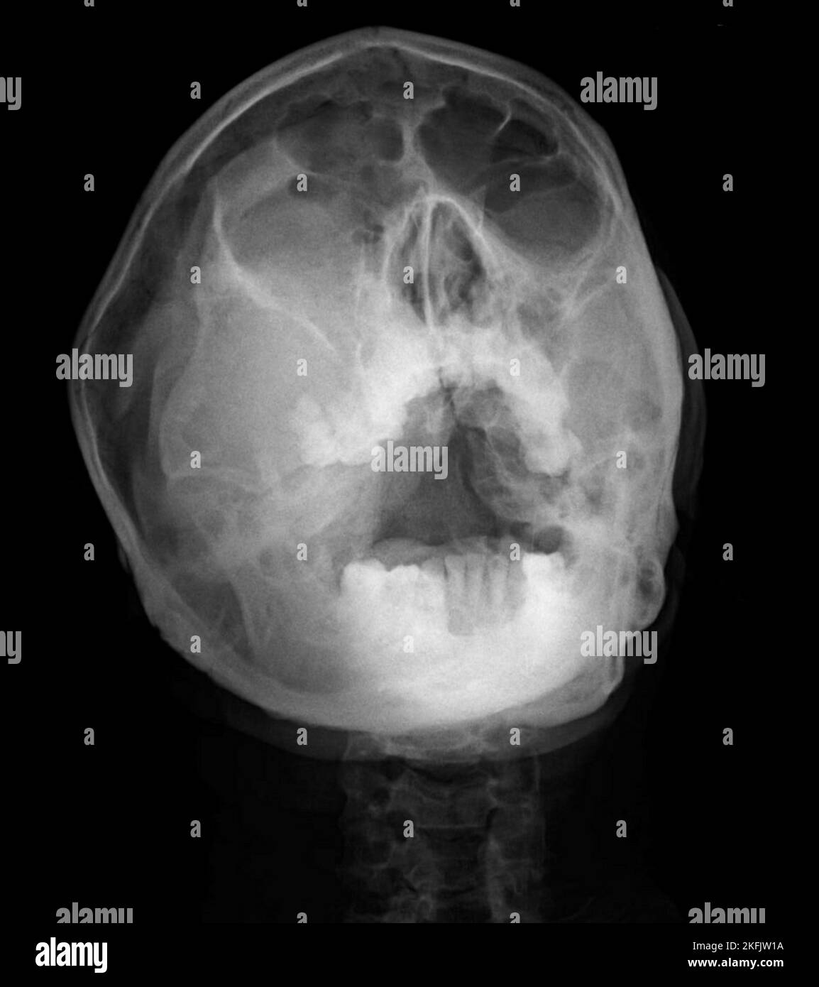 Masse maxillaire, rayons X. Banque D'Images