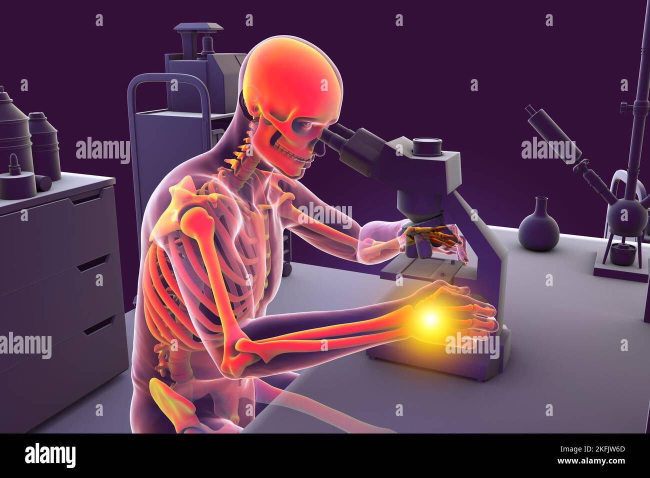 Syndrome du canal carpien chez les travailleurs de laboratoire, illustration Banque D'Images