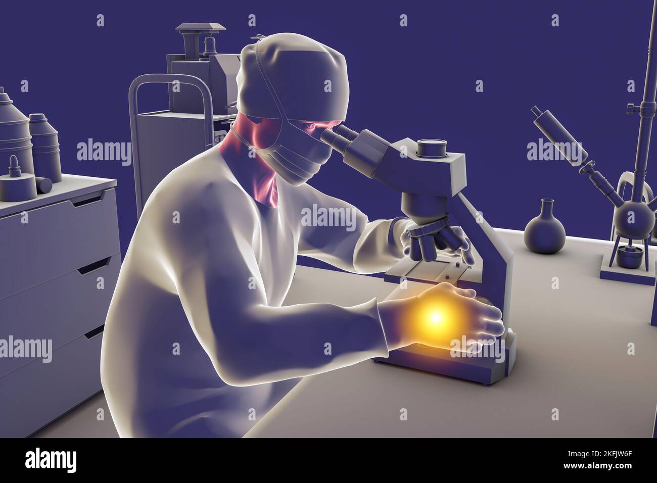 Syndrome du canal carpien chez les travailleurs de laboratoire, illustration Banque D'Images